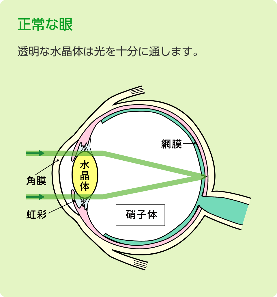 正常な眼