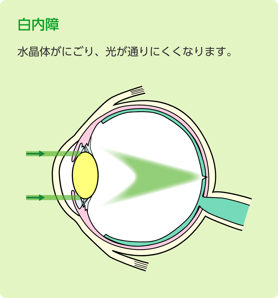 白内障